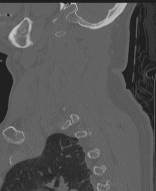 Cerebral hemorrhagic contusions and cervical spine fractures (Radiopaedia 32865-33841 Sagittal bone window 77).jpg