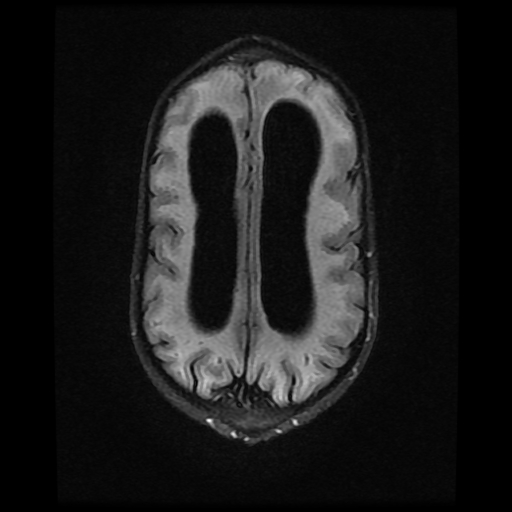 File:Cerebral manifestations of mucopolysaccharidosis type I (Radiopaedia 59171-66487 Axial FLAIR 16).jpg