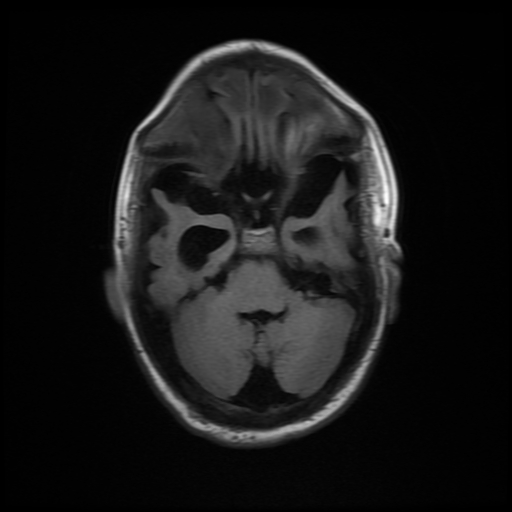 File:Cerebral manifestations of mucopolysaccharidosis type I (Radiopaedia 59171-66487 C 5).jpg