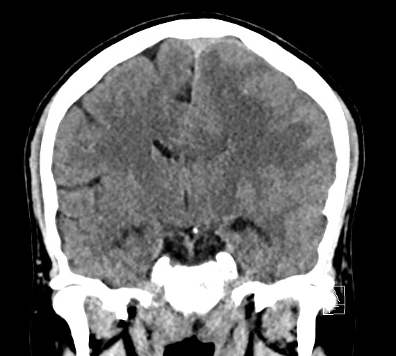 Cerebral metastases - testicular choriocarcinoma (Radiopaedia 84486-99855 Coronal C+ delayed 32).jpg