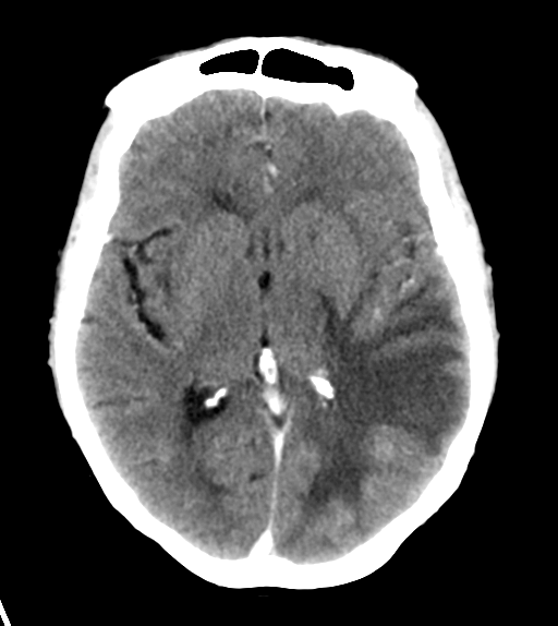 File:Cerebral metastasis (Radiopaedia 46744-51260 Axial C+ delayed 15).png