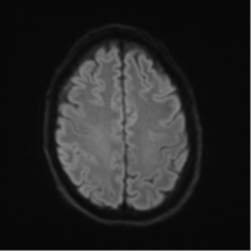 Cerebral metastasis - melanoma (Radiopaedia 54718-60954 Axial DWI 53).png