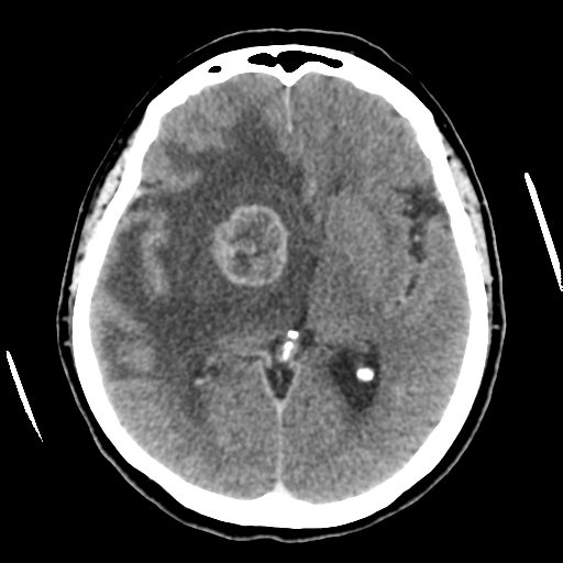 Cerebral metastasis to basal ganglia (Radiopaedia 81568-95412 Axial C+ delayed 30).png