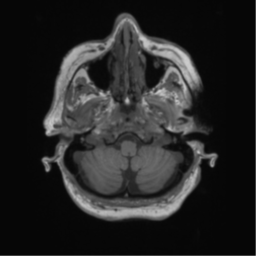 Cerebral metastasis to basal ganglia (Radiopaedia 81568-95413 Axial T1 9).png