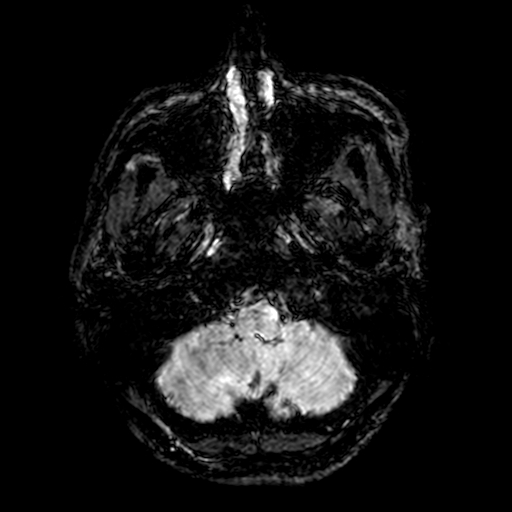 Cerebral parenchymal arteriovenous malformation (Radiopaedia 27280-27456 Axial SWI 1).jpg