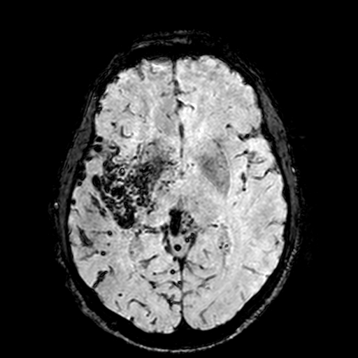 Cerebral parenchymal arteriovenous malformation (Radiopaedia 27280-27456 Axial SWI 57).jpg