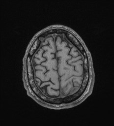 File:Cerebral toxoplasmosis (Radiopaedia 43956-47461 Axial T1 68).jpg