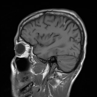 File:Cerebral toxoplasmosis (Radiopaedia 43956-47461 Sagittal T1 5).jpg