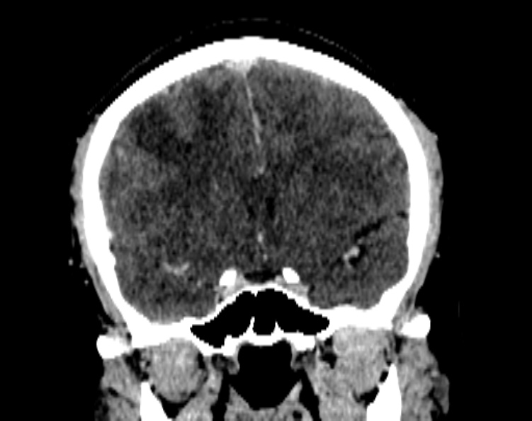 Cerebral venous hemorrhagic infarct from venous sinus thrombosis (Radiopaedia 55433-61883 Coronal C+ delayed 28).jpg