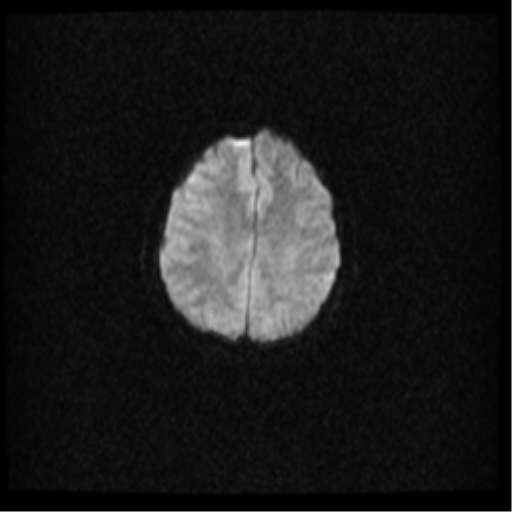 Cerebral venous hemorrhagic infarction (Radiopaedia 38461-40552 Axial DWI 26).png