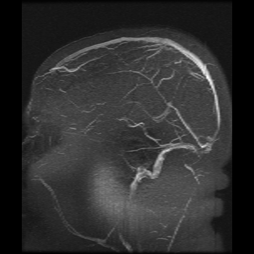 Cerebral venous infarction (Radiopaedia 25109-25396 MRV 2).jpg