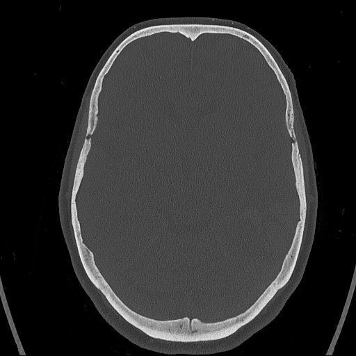 Cerebral venous infarction with hemorrhage (Radiopaedia 65343-74381 Axial bone window 70).jpg