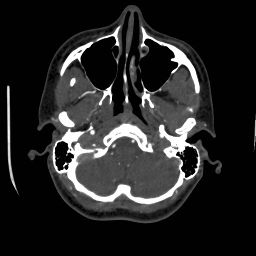 Cerebral venous sinus thrombosis (Radiopaedia 40619-43227 A 33).jpg