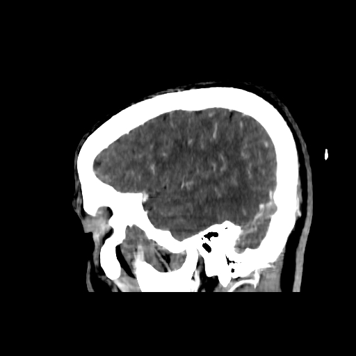 File:Cerebral venous thrombosis (CVT) (Radiopaedia 77524-89685 Sagittal CTV 4).jpg