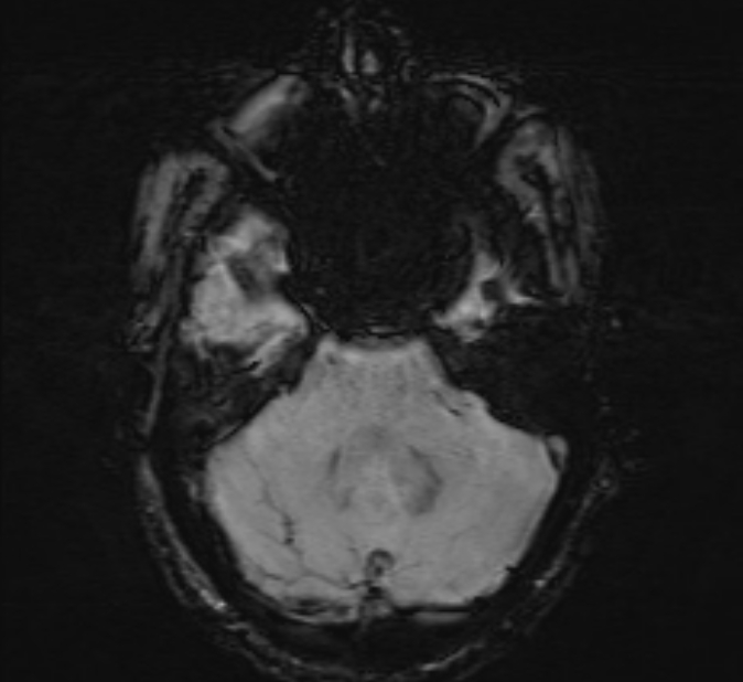Cerebral venous thrombosis (Radiopaedia 71207-81504 Axial SWI 11).jpg
