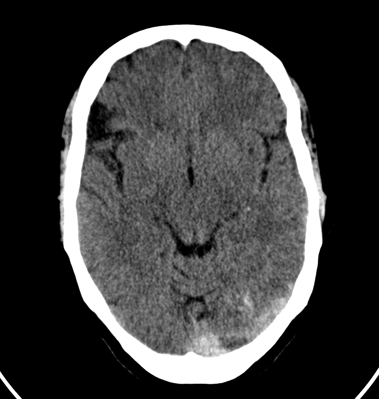 Cerebral venous thrombosis - CT only (Radiopaedia 41031-43778 Axial non-contrast 50).jpg