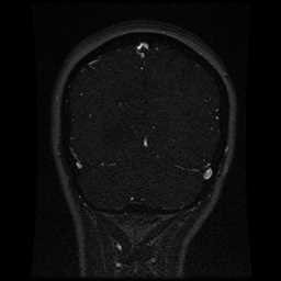 Cerebral venous thrombosis - ulcerative colitis (Radiopaedia 66049-75219 Coronal MRV 29).jpg
