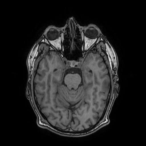 Cerebral venous thrombosis with secondary intracranial hypertension (Radiopaedia 89842-106957 Axial T1 72).jpg