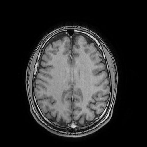 File:Cerebral venous thrombosis with secondary intracranial hypertension (Radiopaedia 89842-106957 Axial T1 C+ 119).jpg