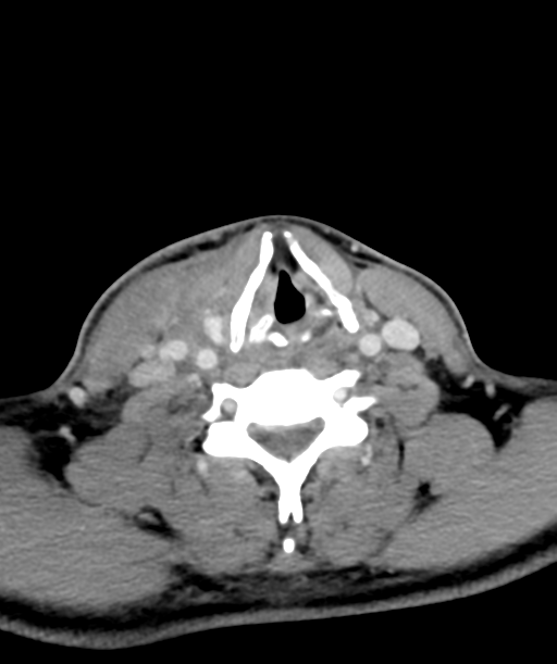 Cervical abscess (Radiopaedia 43725-47184 A 46).png