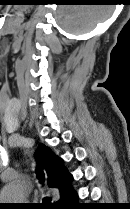 Cervical canal stenosis - OPLL and osteophytes (Radiopaedia 47329-51910 B 57).png