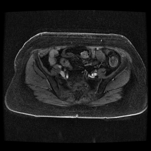 File:Cervical carcinoma (Radiopaedia 70924-81132 Axial T1 C+ fat sat 70).jpg