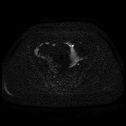 Cervical carcinoma (Radiopaedia 85405-101028 Axial DWI 56).jpg