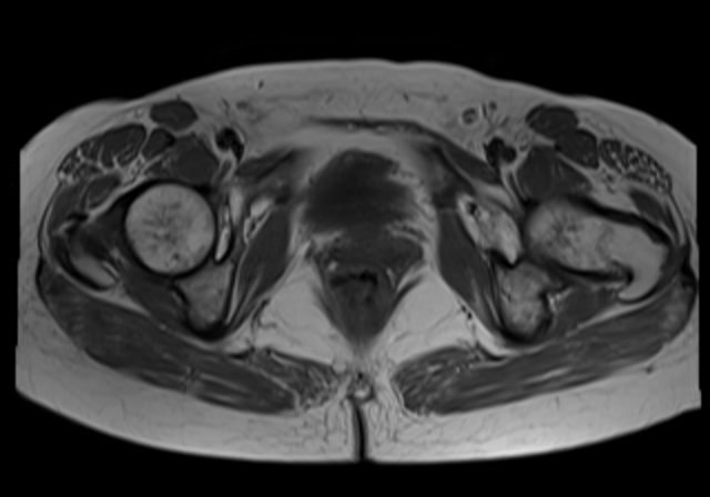 File:Cervical carcinoma (Radiopaedia 88312-104943 Axial T1 17).jpg