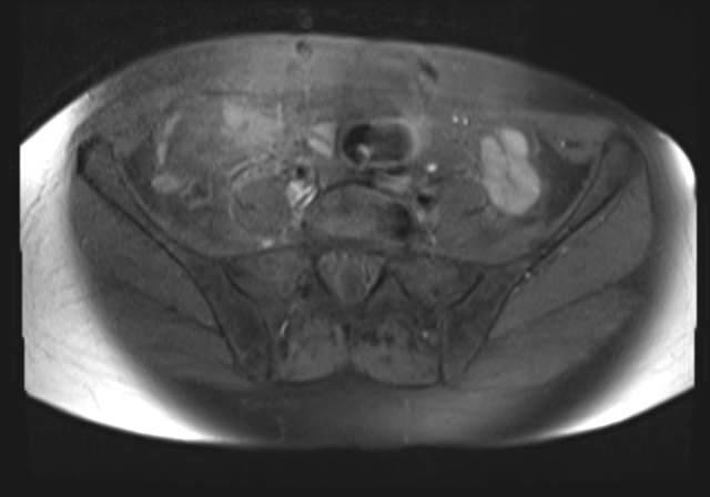 File:Cervical carcinoma (Radiopaedia 88312-104943 Axial T1 fat sat 4).jpg