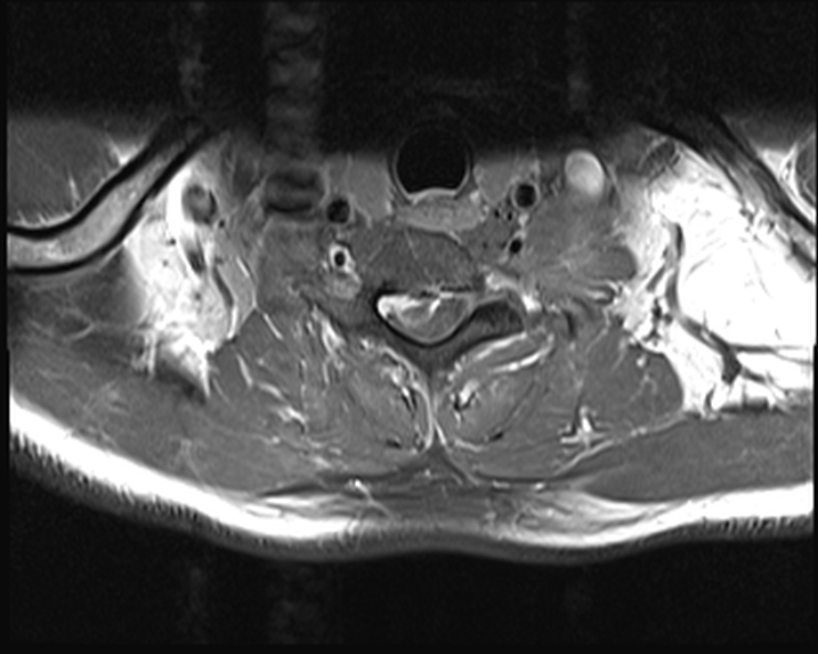 File:Cervical disc extrusion (Radiopaedia 53950-60077 Axial T1 C+ fat sat 22).jpg