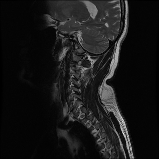 File:Cervical disc extrusion (Radiopaedia 59074-66364 Sagittal T2 2).jpg