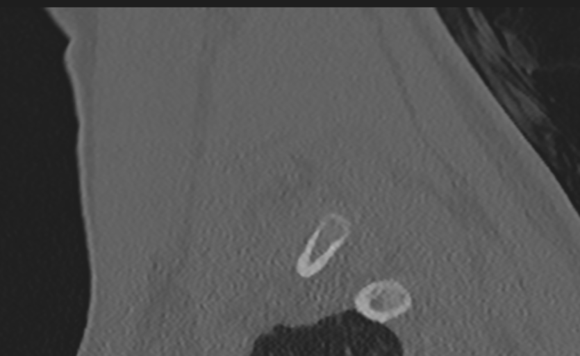 Cervical disc replacement (Radiopaedia 37383-39205 Sagittal bone window 13).png
