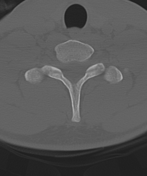 Cervical intercalary bone (Radiopaedia 35211-36748 Axial bone window 53).png
