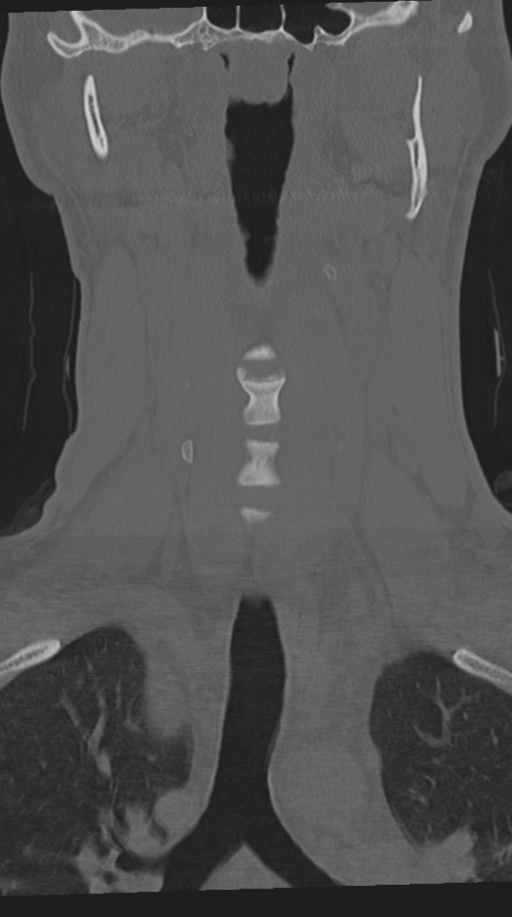 Cervical intercalary bone (Radiopaedia 35211-36748 Coronal bone window 25).png