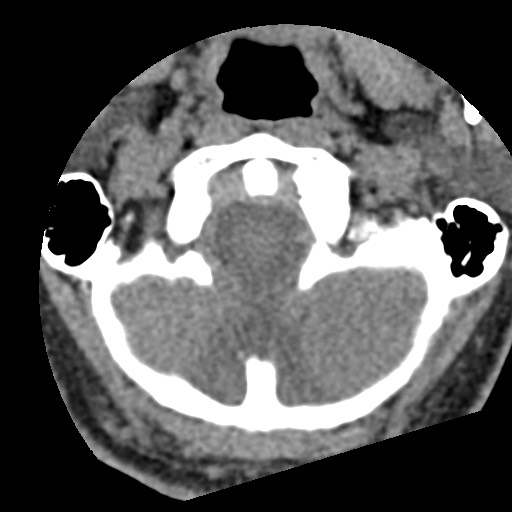 File:Cervical spinal neurofibroma in a patient with NF1 (Radiopaedia 58344-65464 Axial non-contrast 10).jpg