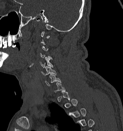 Cervical spine trauma with tear drop fracture and perched facet joint (Radiopaedia 53989-60127 Sagittal bone window 24).jpg