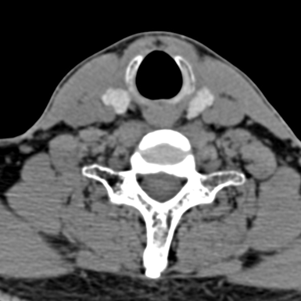 Cervical spondylodiscitis (Radiopaedia 28057-29489 Axial non-contrast 58).jpg