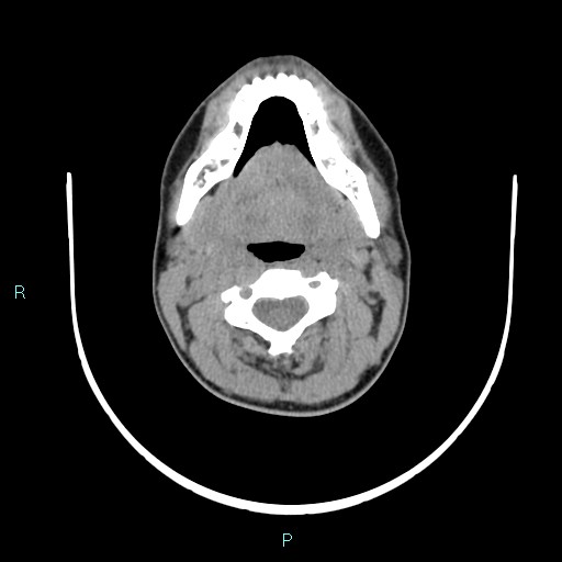 File:Cervical thymic cyst (Radiopaedia 88632-105335 Axial non-contrast 78).jpg