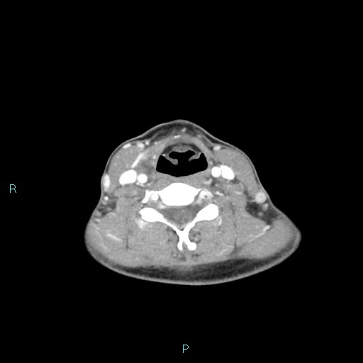 Cervical thymic cyst (Radiopaedia 88632-105335 B 52).jpg