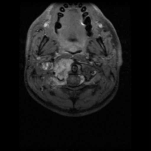 File:Cervical vertebrae metastasis (Radiopaedia 78814-91667 Axial T1 C+ fat sat 11).png