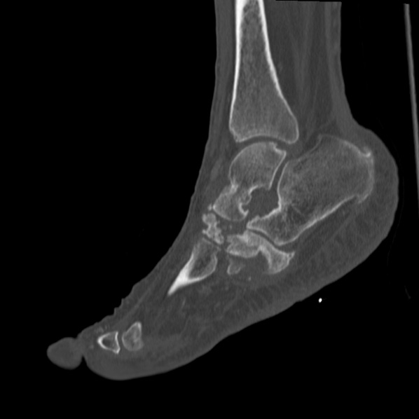 Charcot joint (Radiopaedia 36629-38194 Sagittal bone window 43).jpg