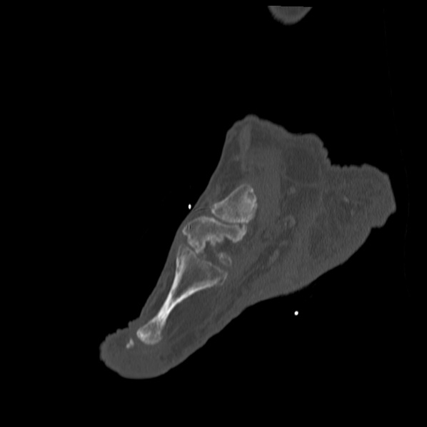 Charcot joint (Radiopaedia 36629-38194 Sagittal bone window 69).jpg