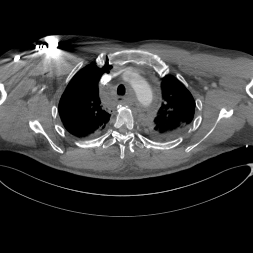 File:Chest multitrauma - aortic injury (Radiopaedia 34708-36147 A 76).png