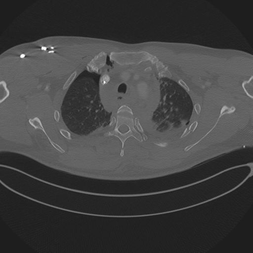 Chest multitrauma - aortic injury (Radiopaedia 34708-36147 Axial bone window 69).png