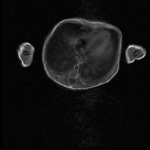 File:Chiari II malformation with spinal meningomyelocele (Radiopaedia 23550-23652 Axial T1 6).jpg