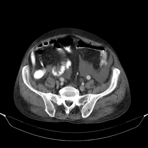 File:Cholangitis and abscess formation in a patient with cholangiocarcinoma (Radiopaedia 21194-21100 A 38).jpg