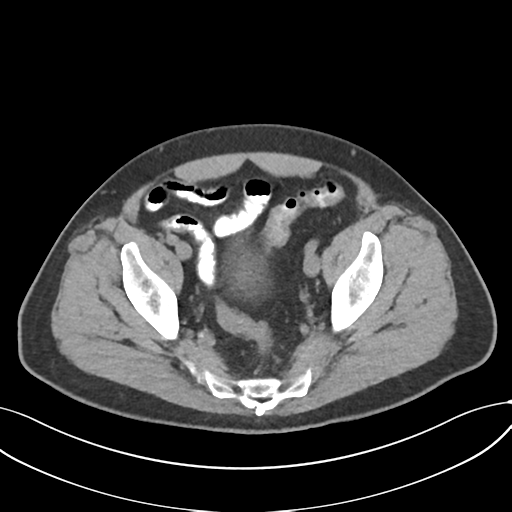 Cholecystitis with focal perforation and hepatic abscess (Radiopaedia 37189-38945 Axial non-contrast 73).png