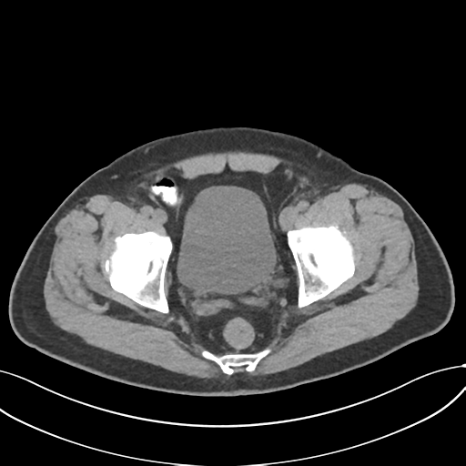 File:Cholecystitis with focal perforation and hepatic abscess (Radiopaedia 37189-38945 Axial non-contrast 78).png