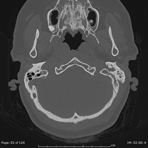Cholesteatoma - external auditory canal (Radiopaedia 88452-105096 Axial bone window 15).jpg