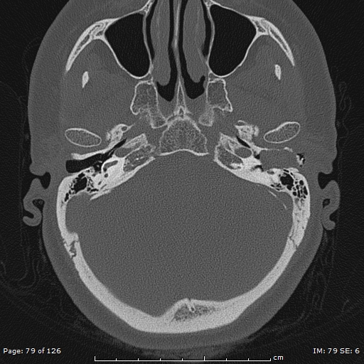 Cholesteatoma - external auditory canal (Radiopaedia 88452-105096 Axial bone window 42).jpg
